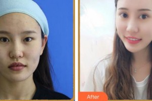 合肥凱美醫(yī)療美容醫(yī)院柳重錫整形價(jià)格表附眼部綜合案例展示