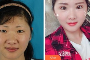 合肥臺美醫(yī)療美容門診部劉建龍整形價(jià)格表附切開雙眼皮案例展示