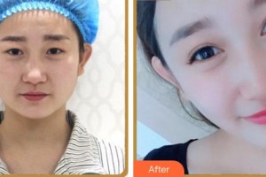 合肥艾雅整形美容醫(yī)院楊海平整形價(jià)格表附眼部綜合案例展示