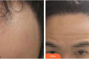 合肥源森美容整形外科診所周芳整形價(jià)格表附發(fā)際線案例展示