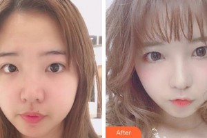 合肥翡睿醫(yī)療美容門診部楊森整形價(jià)格表附眼部綜合案例展示