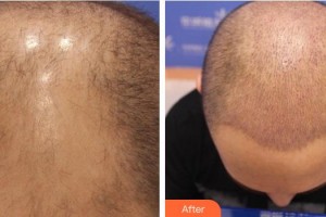 合肥叢生醫(yī)療美容門診部王順霞整形價(jià)格表附頭頂加密種植案例展示