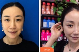 合肥美舒雅醫(yī)療美容診所王軍整形價(jià)格表附埋線提升案例展示