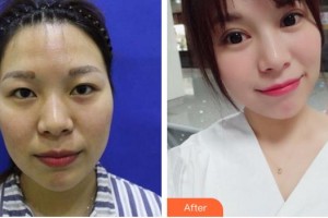 合肥美舒雅醫(yī)療美容診所高偉整形價格表附眼部綜合案例展示