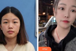 合肥名人眼科醫(yī)院梁祖剛整形價格表附上瞼提肌案例展示