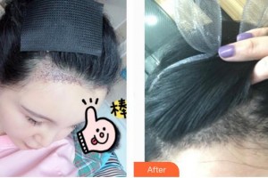 合肥新生植發(fā)醫(yī)院劉維整形價格表附種植發(fā)際線案例展示