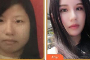 合肥名人眼科醫(yī)院楊友俊整形價格表附眼部綜合案例展示