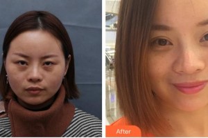 合肥名人眼科醫(yī)院岳春整形價格表附重瞼修復(fù)術(shù)+上瞼提肌矯正術(shù)案例展示