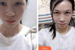 合肥愛爾眼科醫(yī)院朱華美整形價格表附眼部修復(fù)案例展示