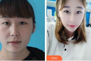 合肥愛爾眼科醫(yī)院蔣寶霖整形價格表附眼部綜合案例展示