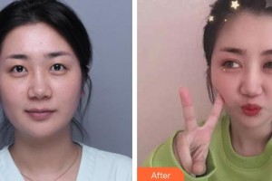 合肥愛爾眼科醫(yī)院謝道勝整形價格表附雙眼皮案例展示