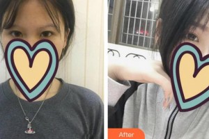 合肥愛爾眼科醫(yī)院王芳榮整形價格表附眼部案例展示