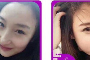 合肥愛爾眼科醫(yī)院劉勇整形價格表附眼部綜合案例展示