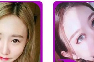 合肥愛(ài)爾眼科醫(yī)院劉琴整形價(jià)格表附眼部整形案例展示