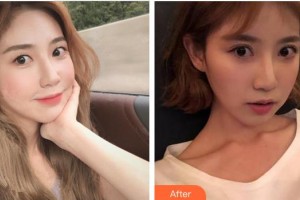 合肥愛(ài)爾眼科醫(yī)院胡盼整形價(jià)格表附切開(kāi)雙眼皮案例展示