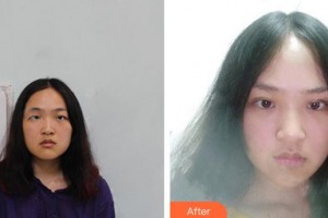 合肥愛(ài)爾眼科醫(yī)院殷西亮整形價(jià)格表附雙眼皮案例展示