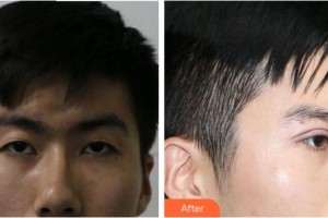 合肥愛(ài)爾眼科醫(yī)院李萍整形價(jià)格表附埋線(xiàn)雙眼皮案例展示