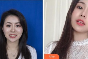 合肥市口腔醫(yī)院孫珍整形價(jià)格表附隱形矯正案例展示