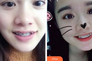 合肥市口腔醫(yī)院劉昕整形價(jià)格表附金屬托槽矯正案例展示