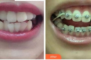 合肥市口腔醫(yī)院張富華整形價(jià)格表附金屬托槽矯正案例展示