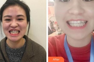 合肥拜博口腔醫(yī)院杜紅保整形價(jià)格表附冷光美白案例展示