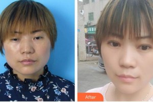 合肥東南眼科醫(yī)院葉玉華整形價(jià)格表附上瞼下垂、內(nèi)眼角案例展示