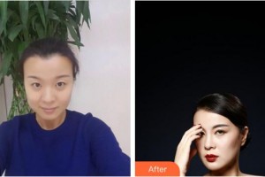 合肥東南眼科醫(yī)院張志明整形價(jià)格表附切開雙眼皮案例展示