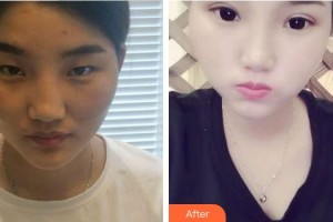 合肥東南眼科醫(yī)院汪澤整形價(jià)格表附切開雙眼皮案例展示