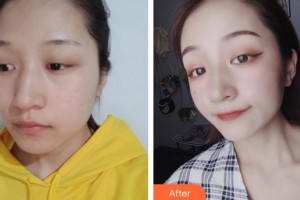 合肥東南眼科醫(yī)院夏博整形價(jià)格表附開內(nèi)眼角案例展示