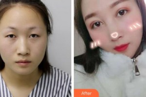 合肥東南眼科醫(yī)院楊建東整形價(jià)格表附眼部綜合案例展示