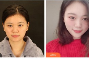 合肥普瑞眼科醫(yī)院朱鳳整形價(jià)格表附切開雙眼皮案例展示