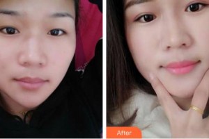 合肥普瑞眼科醫(yī)院馮晴整形價(jià)格表附埋線雙眼皮案例展示