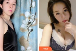 蕪湖伊萊美整形醫(yī)院王世宏整形價(jià)格表附隆胸案例展示