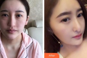 蕪湖伊萊美整形醫(yī)院何一波整形價(jià)格表附鼻部綜合案例展示