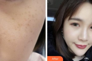 蕪湖瑞麗醫(yī)療美容門診部樊喜林整形價(jià)格表附超激光美膚案例展示