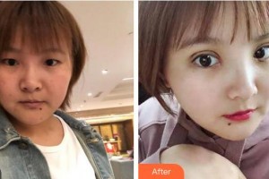 蕪湖瑞麗醫(yī)療美容門診部王俞明整形價(jià)格表附切開雙眼皮案例展示