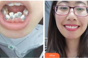 蕪湖壹加壹整形美容醫(yī)院蘭春祥整形價(jià)格表附金屬托槽矯正案例展示