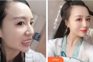 蕪湖壹加壹整形美容醫(yī)院馬小兵整形價(jià)格表附牙齒隱形矯正案例展示