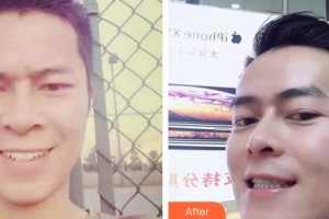 蕪湖美人魚醫(yī)療美容醫(yī)院王俊整形價(jià)格表附金屬托槽矯正案例展示