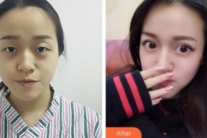 蕪湖一秒醫(yī)療美容醫(yī)院王惠梅整形價(jià)格表附雙眼皮案例展示