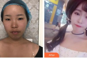 蕪湖眼科醫(yī)院（弋江區(qū)醫(yī)院）高際平整形價(jià)格表附切開雙眼皮案例展示