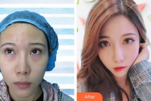 蕪湖眼科醫(yī)院（弋江區(qū)醫(yī)院）張雷整形價(jià)格表附內(nèi)切祛眼袋案例展示