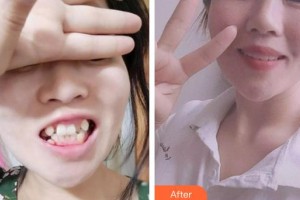 蕪湖來友口腔門診部張來友整形價(jià)格表附金屬托槽矯正案例展示