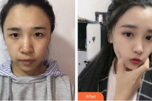 蚌埠國色整形美容醫(yī)院程新德整形價(jià)格表附眼部綜合案例展示