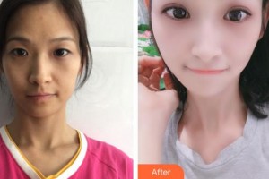 蚌埠國(guó)色整形美容醫(yī)院朱寶玉整形價(jià)格表附眼部綜合案例展示