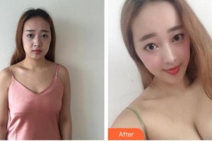 蚌埠市第三人民醫(yī)院燒傷整形科許瑾整形價(jià)格表附假體隆胸案例展示