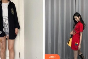 蚌埠市第三人民醫(yī)院燒傷整形科李勇整形價(jià)格表附微創(chuàng)疤痕修復(fù)案例展示