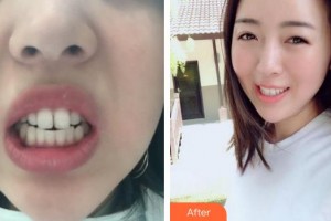 蚌埠韓麗整形美容醫(yī)院張建鋒整形價(jià)格表附牙齒矯正案例展示