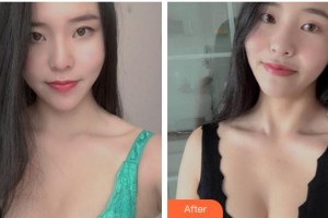 蚌埠美愿醫(yī)療整形醫(yī)院李鴻君整形價(jià)格表附豐胸案例展示