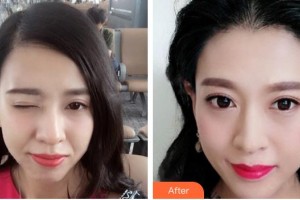 蚌埠韓麗整形美容醫(yī)院曺在賢整形價(jià)格表附種植發(fā)際線案例展示